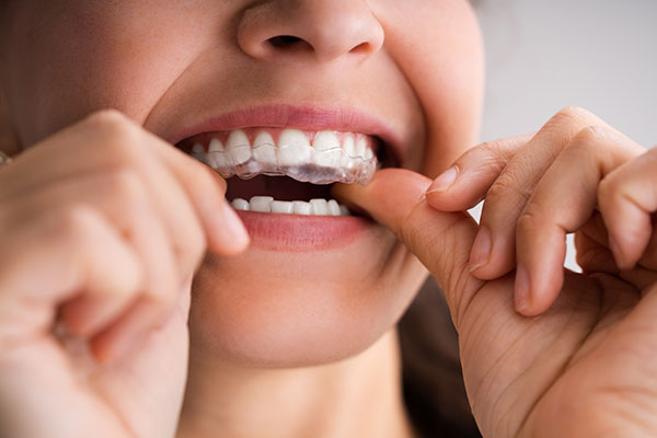 Clear aligners are available at Morris Dental Care, Oldham