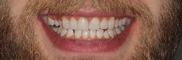 Crowns and Veneers - after treatment results