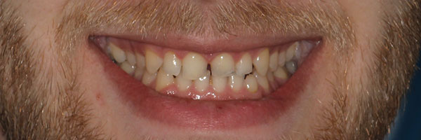 Stained, misshapen or chipped teeth can be rectified with crowns and/or veneers.