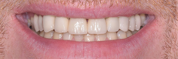 Crowns and Veneers - after treatment results