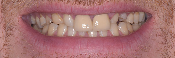 Stained, misshapen or chipped teeth can be rectified with crowns and/or veneers.