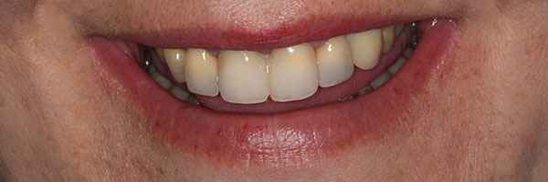 After mouth rehabilitation treatment using various specialist treatments. 