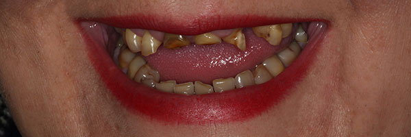 Mouth rehabilitation - damaged teeth can be treated or replaced to give our patients a healthy mouth and a lovely smile. 