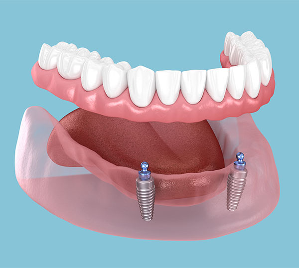 Custom crafted inplant retained dentures designed by Morris Dental Care 