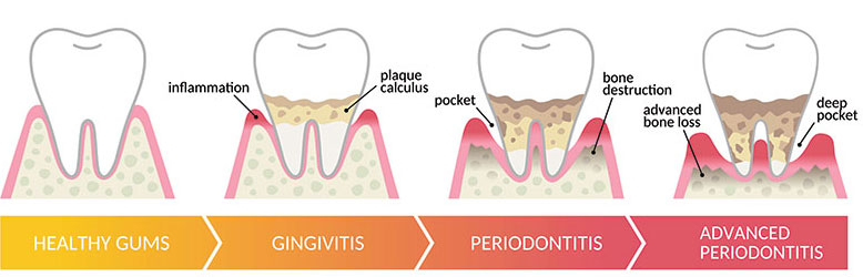 How to spot the different stages of gum disease (periodontitis)