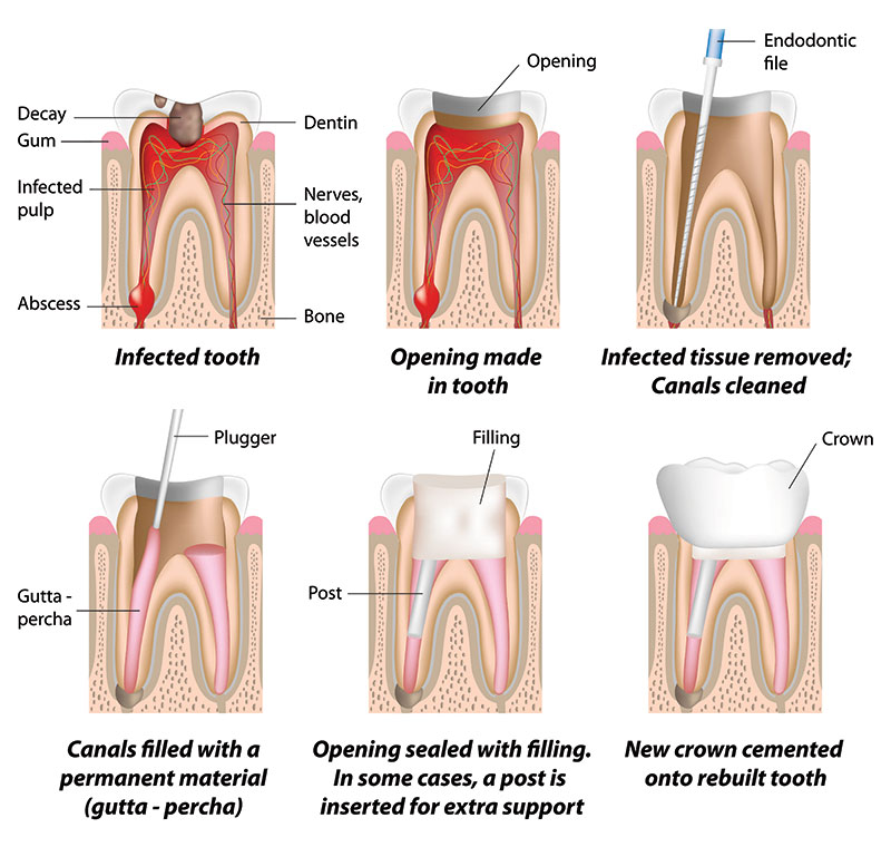 Complex root canal treatment is available from Morris Dental Care 